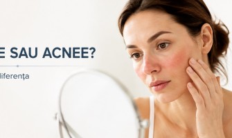 Rozacee vs Acnee: Cum Recunoști Diferența și Ce Poți Face